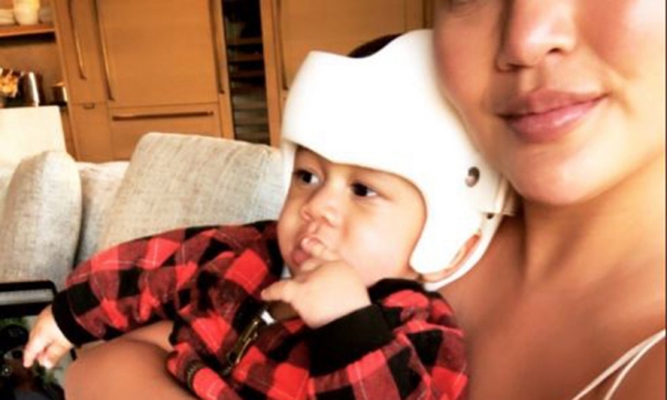 Chrissy Teigen reveals why baby son Miles needs corrective helmet