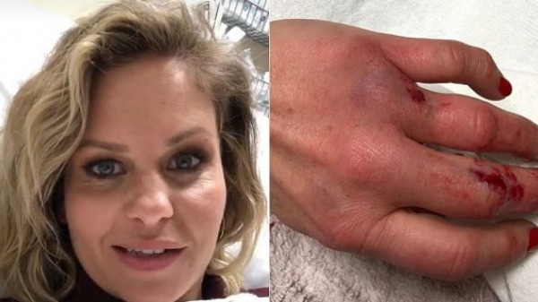Candace Cameron Bure shows off grisly hand injury that left her hospitalized